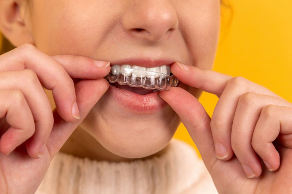 Invisalign som moderne og nesten usynlig tannregulering